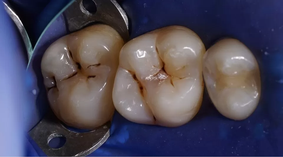 Микроинвазивное лечение кариеса 5 и 6 зуба. Восстановление анатомии.